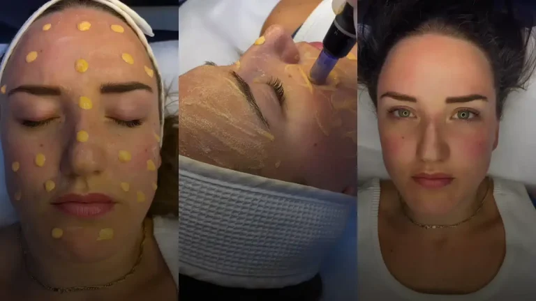Scar Camouflage: Expert Tips for Dubai Residents